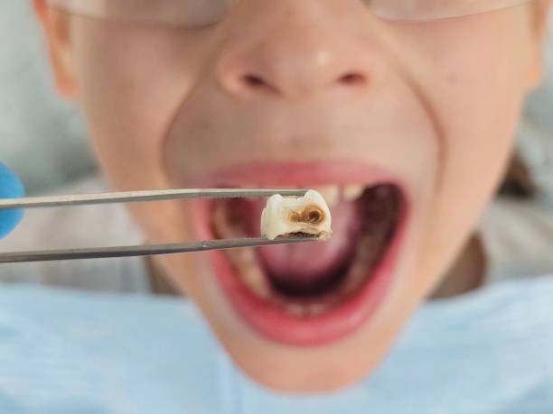 Best Emergency Tooth Extraction in Wake Village, TX